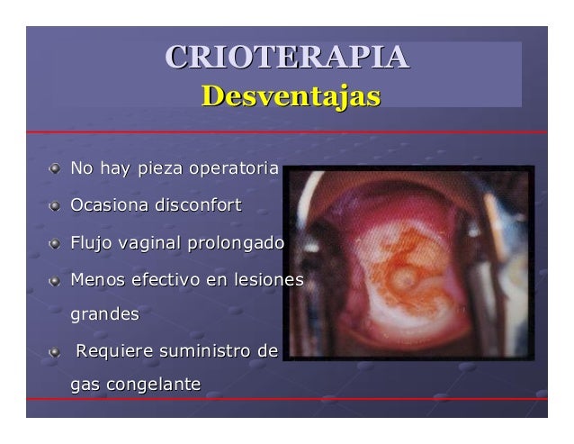 crioterapia cervical